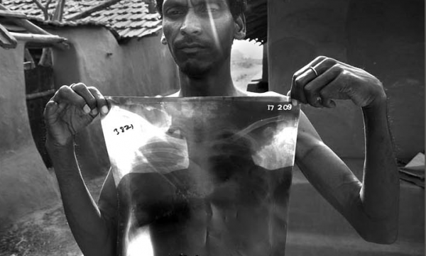 Indian man holding up a chest X-ray scan confirming tuberculosis (TB)